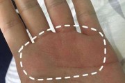 键盘使用后手部发痒是什么原因？如何预防？
