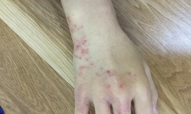 键盘使用后手部发痒是什么原因？如何预防？