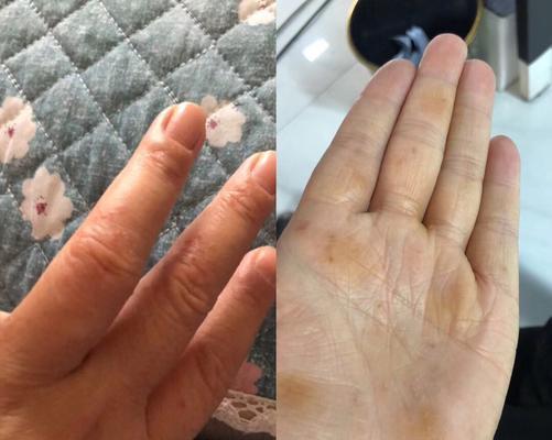 键盘使用后手部发痒是什么原因？如何预防？